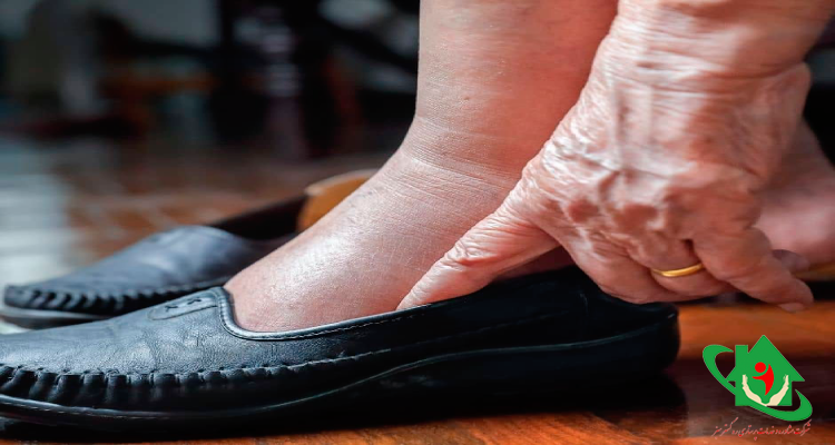 علت ورم پا در سالمندان و روش های درمان آن